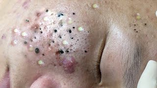 Big Cystic Acne Blackheads Extraction Blackheads amp Milia Whiteheads Removal Pimple Popping  9283 [upl. by Domenico]