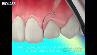 Gingivectomy Biolase  Streamhealth Dental [upl. by Emily]