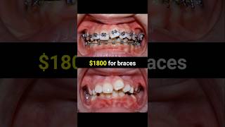 Braces transformation 36 months braces orthodontist dentist nhakhoaocare [upl. by Winters149]