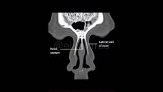 Coronal CT section of nose and paranasal sinuses [upl. by Harifaz]