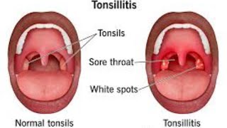 شرح Tonsillitis بالتفصيل 💗💯🔥 [upl. by Quin139]