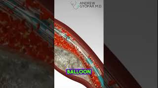 Saving Hearts  Angioplasty Stent Placement HealthAdvice MedicalTips Medicine101 [upl. by Nylesaj]