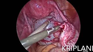 Prof Dr Alka Kriplani  Lap Paraovarian Cystectomy [upl. by Joappa]