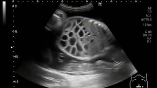 Ultrasound Video showing dilated gut loops of the fetus and anomalies [upl. by Amis]