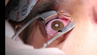 Corneal Iontophoresis Procedure [upl. by Carlson]