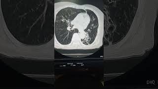 Bilateral bronchiectasis on CT scan CT scan chest interpretation [upl. by Eniamrehs305]