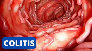 La COLITIS explicada síntomas tipos consecuencias tratamiento prevención [upl. by Moulden]