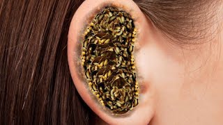 ASMR video night sleep Remove Bee sting Ear 👂 Big yellow Infected kany the ear ASM Feroz [upl. by Lledniuq]