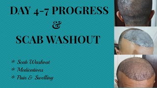 Hair transplant  Progress Day 47 amp Scab Washout [upl. by Adrell]