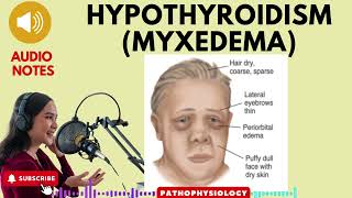 Hypothyroidism Myxedema Causes SignsSymptoms amp treatment [upl. by Iorgo]