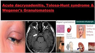 Acute dacryoadenitis Tolosa–Hunt syndrome amp Wegeners Granulomatosis kanskiseries 2022 2023 [upl. by Aisilef]