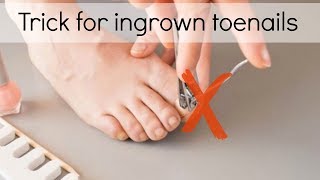 How to Fix Ingrown Toenails Easily [upl. by Cymbre508]