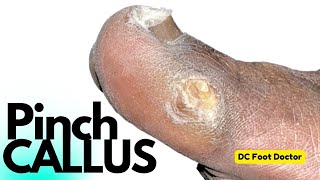 The Pinch Callus Removal of a Common Foot Problem [upl. by Onairda]