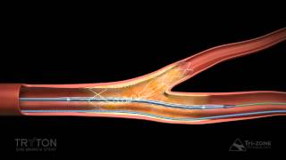 Tryton Side Branch Stent Deployment Sequence [upl. by Samuella]