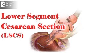 What is LSCS delivery Are you awake during an emergency C section  Dr Mini Salunkhe of C9 [upl. by Vevay]