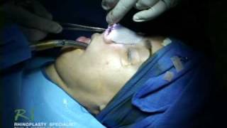 Dr Nassifs Closed Rhinoplasty How To  Exposing Nasal Skeleton [upl. by Garrek]