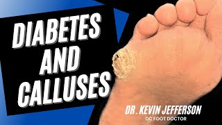 Diabetes and Calluses Removal of Thick Hard Calluses from Diabetes [upl. by Judson548]