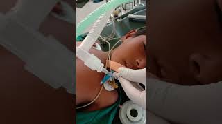 5 point auscultation for confirming position of endotracheal tube in trachea anaesthesia shorts [upl. by Zeiler]