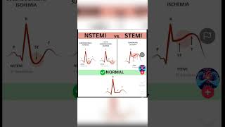 NSTEMI VS STEMI [upl. by Selokcin]