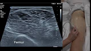 Hamstring Ultrasound 101 [upl. by Ecnaled]