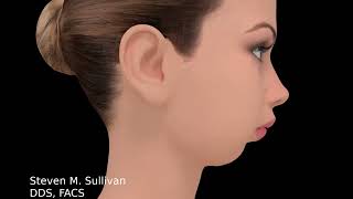 TMJ Total Joint Replacement animation  Dr Steven Sullivan [upl. by Otrebogad]