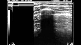 Normal lung vs pneumothorax [upl. by Ylrebme]