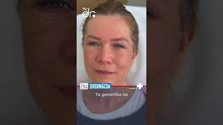 MUDr T Ventrubua PhD povie o technikách omladenia a jeho obľúbenom facelifte facelift vlift [upl. by Medea918]