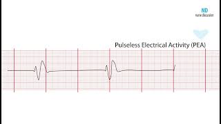 Pulseless Electrical Activity PEA ECG Review Learn the Heart [upl. by Eyssej]