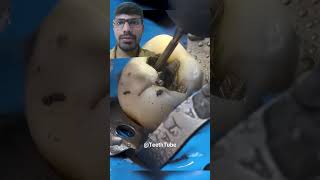 amezing silver amalgam restoration removal dentist dentalfilling satisfying shorts [upl. by Ofelia]