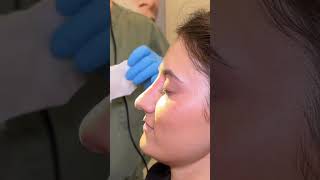 NOSE JOB IN TEN MINUTES plasticsurgery filler liquidrhinoplasty [upl. by Acinor13]