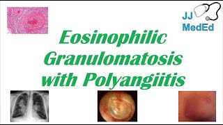 Eosinophilic Granulomatosis with Polyangiitis EGPA  ChurgStrauss Syndrome Autoimmune Vasculitis [upl. by Nnav]