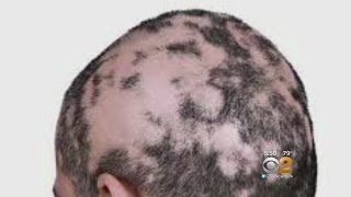 Dr Max Gomez Alopecia Treatment [upl. by Buffy42]