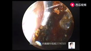 Cleaning cholesteatoma of external auditory canal and tympanic enucleation with otoendoscopy [upl. by Ahsekel]