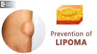 Prevent Lipomas From Occurring  Fatty Lump  Fatty Tumor  Dr Sahebgowda Shetty  Doctors Circle [upl. by Ahcarb]