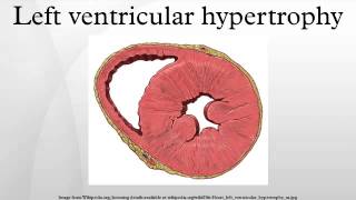 Left ventricular hypertrophy [upl. by Rosemaria]