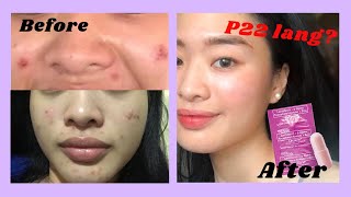 ANTIACNE PILL  LACTEZIN 💊  1 WEEK REVIEW ♡ [upl. by Asfah482]