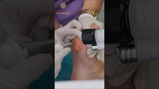 Plantar Warts Removal at Skin Arts Aesthetics Book your appointment today [upl. by Dennet]