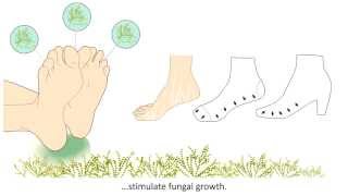 Onychomycosis  What is it and how is it treated [upl. by Akiwak799]