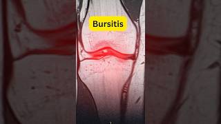 What is Bursitis drmuhammedziya humanbody discover anatomy bursitis knee shoulder [upl. by Kellyann557]