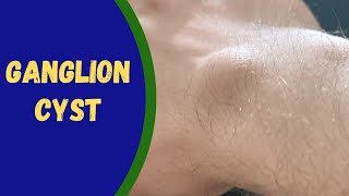 What is Ganglion cyst [upl. by Kluge160]