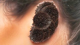 ASMR Deep Ear Care Treatment  ASMR Ear Wax Maggots Remove From Ear  ASMR Ear Wax [upl. by Tsai]