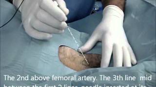 Obturaor nerve block modified inguinal technique nerve stimulaionwmv [upl. by Kalvn548]