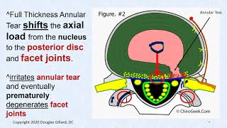 Anatomy of the Nucleus Pulposus amp Annulus Fibrosus  the Effect of Annular Tears [upl. by Marybella]