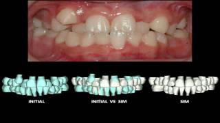 Dynamic simulation with SureSmile software [upl. by Quar]