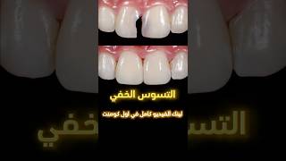 التسوس الخفي Hidden tooth decaydrabdullahsultandentist اسنان dentistry دكتور ترند اكسبلور [upl. by Cosmo581]