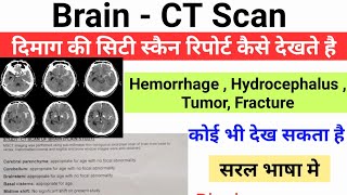 Brain CT Scan report कैसे देखते है  Brain CT Scan in simple language [upl. by Weisburgh]