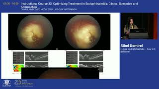 4 Fungal endophthalmitis – how is it different [upl. by Eenalem984]