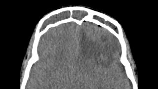 Intracranial abscess  complicated sinusitis [upl. by Adnamas589]