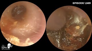 1569  Challenging ear wax removal in stenotic ear canal using both iCLEARscope amp WAXscope [upl. by Anyt]