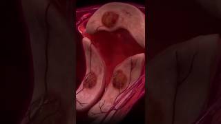 How Does Uterine Fibroid Embolization UFE work uterinehealth womenshealth healthshorts shorts [upl. by Durgy]